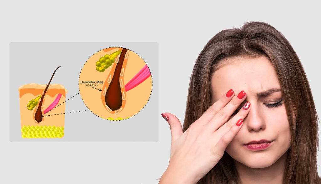 Know the mites those causing discomforts in your eyes