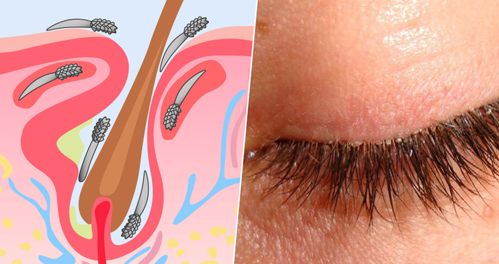 In most cases Blepharitis is caused by Demodex and needs an aggressive management by doctors & patients