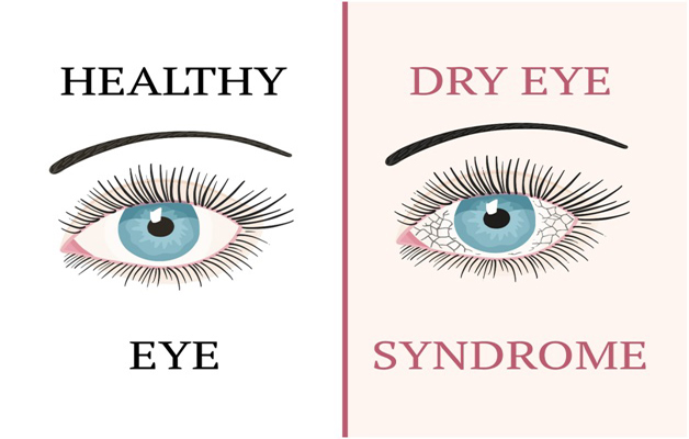 Do you suffer either of Dry Eyes, Blepharitis MGD, Computer Vision Syndrome (CVS) and Demodex Infestation?