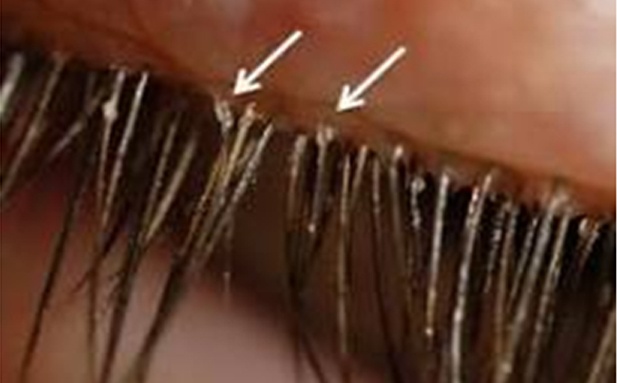 Know more about Blepharitis, Causes and managing Eyelid Hygiene.