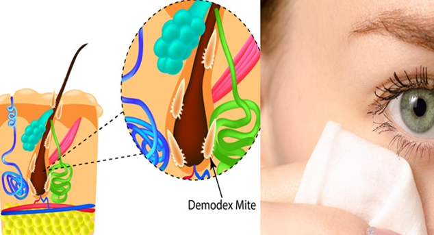 Get rid of Demodex mites right now, these commonly find on eyelids and eyelashes!